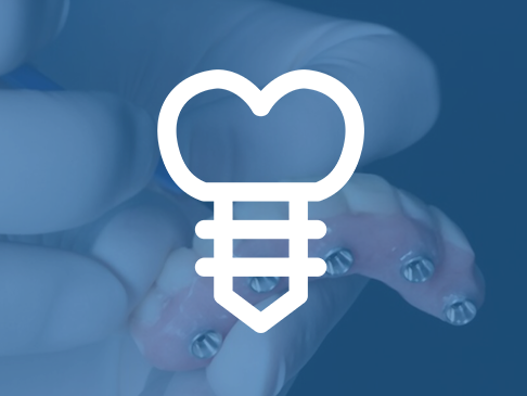 All On Four Implant Treatment
