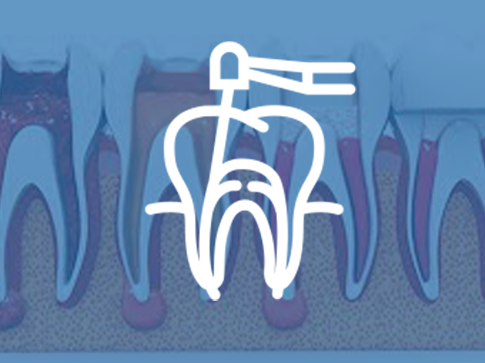 Endodontic (Root Canal Treatment)