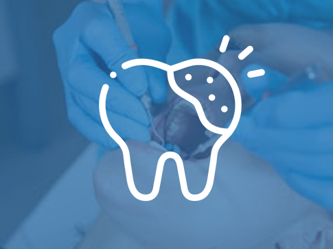Tooth Decay Treatment