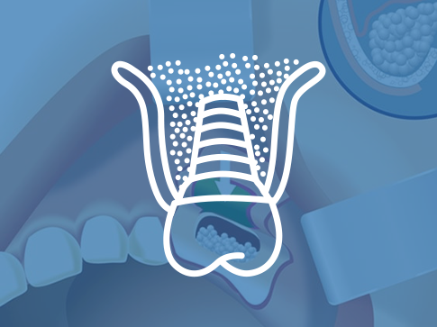Sinus Lift Surgery